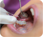 歯周病治療画像