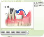 歯の移植画像